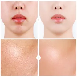 Hyaluronic acid face serum - moisturizing - shrink pores - acne marks removal - nourishingSkin