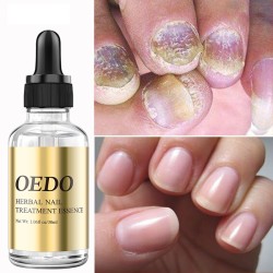 Fungal nail treatment - essential oilTreatment